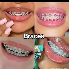 teeth-fashion-braces-in-lekki