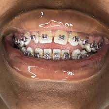 teeth-fashion-braces-in-lekki