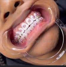 teeth-fashion-braces-in-lekki