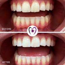 teeth-whitening-in-lekki