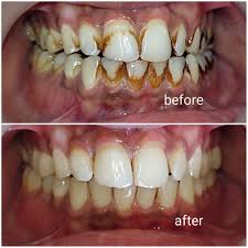 teeth-whitening-in-lekki